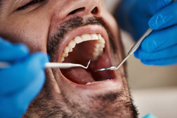 Best Chipped Tooth Repair Near Me  in Coconut Creek, FL